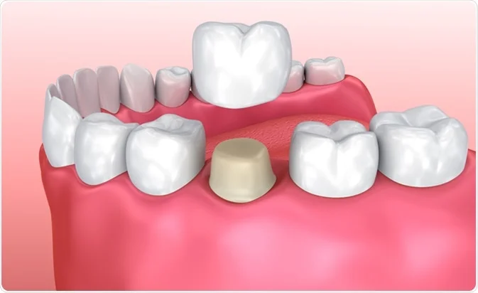 What To Anticipate When Getting A Dental Crown?