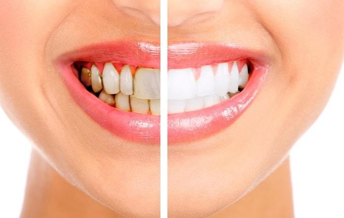 Teeth Whitening in Bismarck, ND: Is It for You?