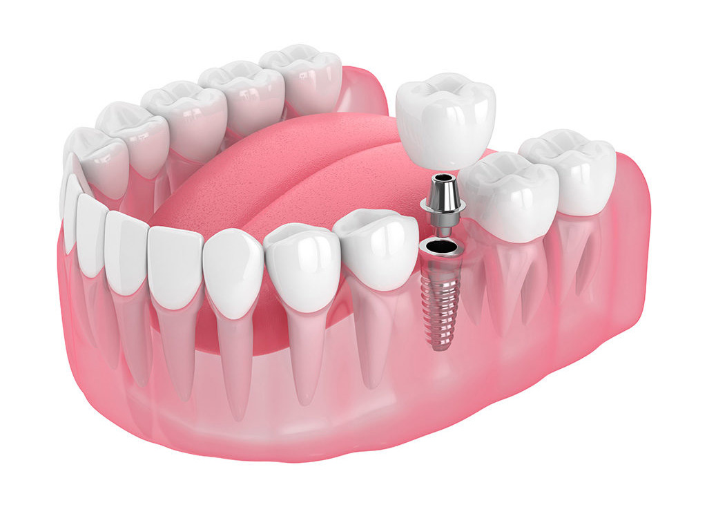 Want to Get Dental Implants in Fort Myers? Here are Things You Must Know About Them