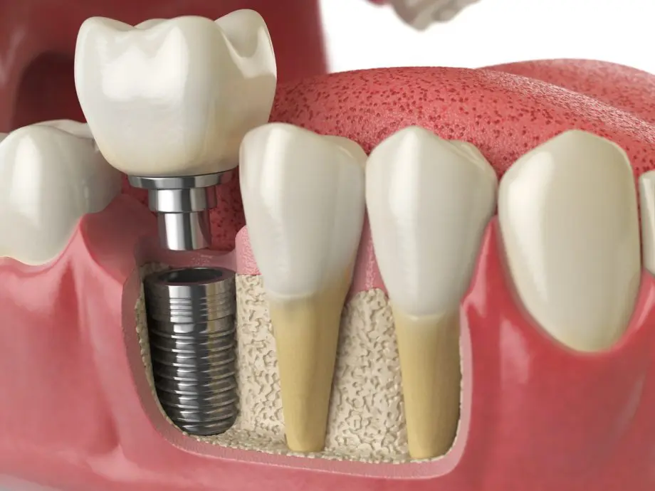 What Are the Biggest Benefits of Dental Implants? 