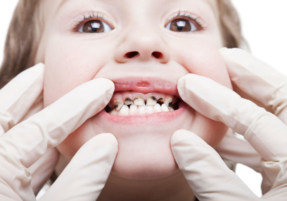 Causes of Dental Problems Among Infants