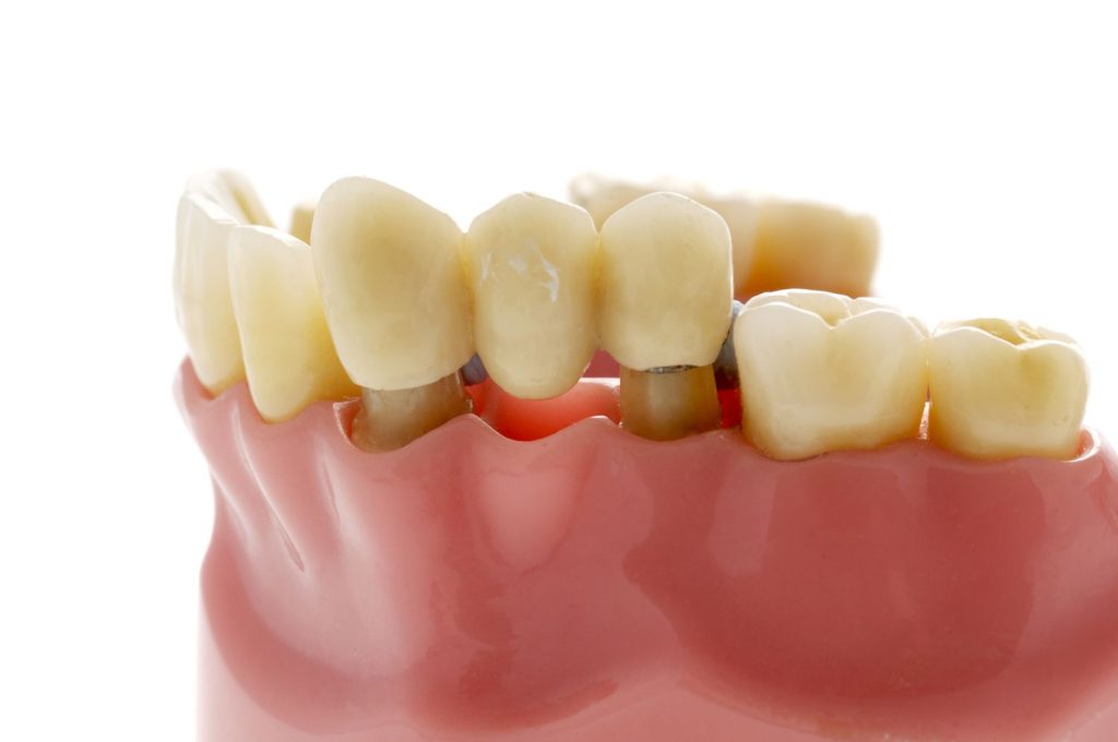Dental bridge 101: All you need to know about the procedure
