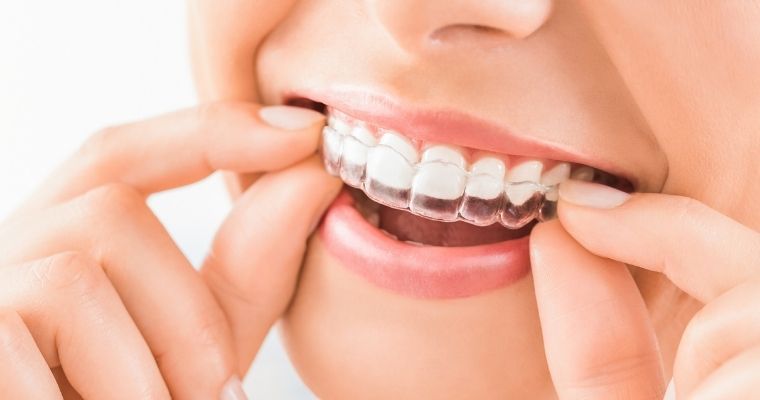 Is Invisalign Right for Your Kids?