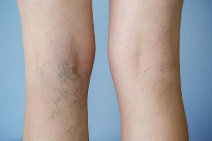 Reviewing common treatments for varicose veins in South Carolina