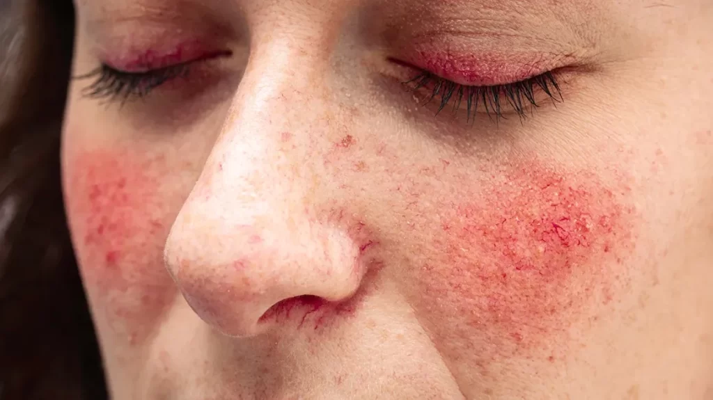 Dermatologists And Rosacea: Understanding The Condition