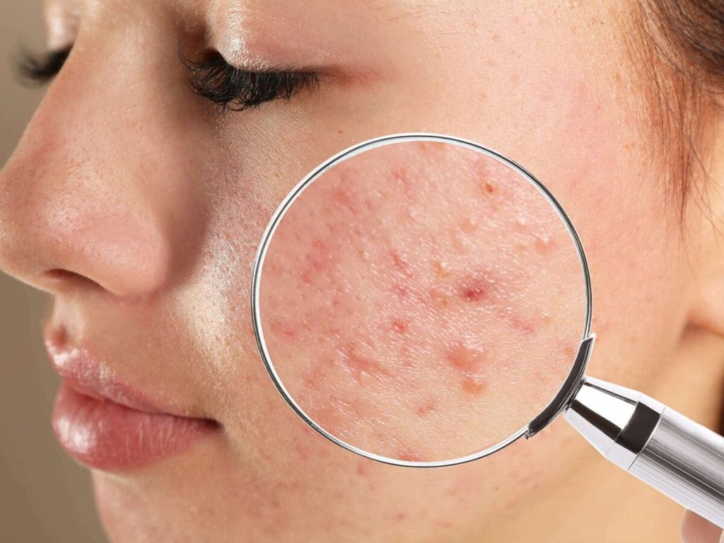 Top Acne Treatments Available in Singapore